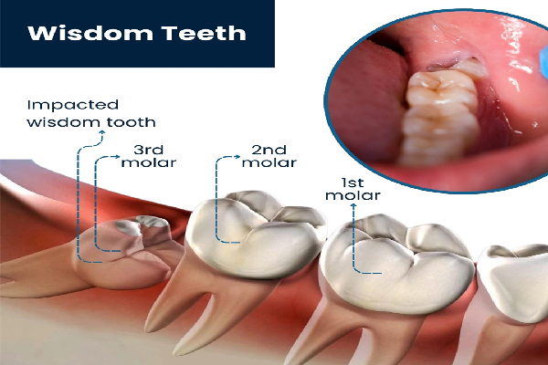 Wisdom Tooth Extraction Procedure